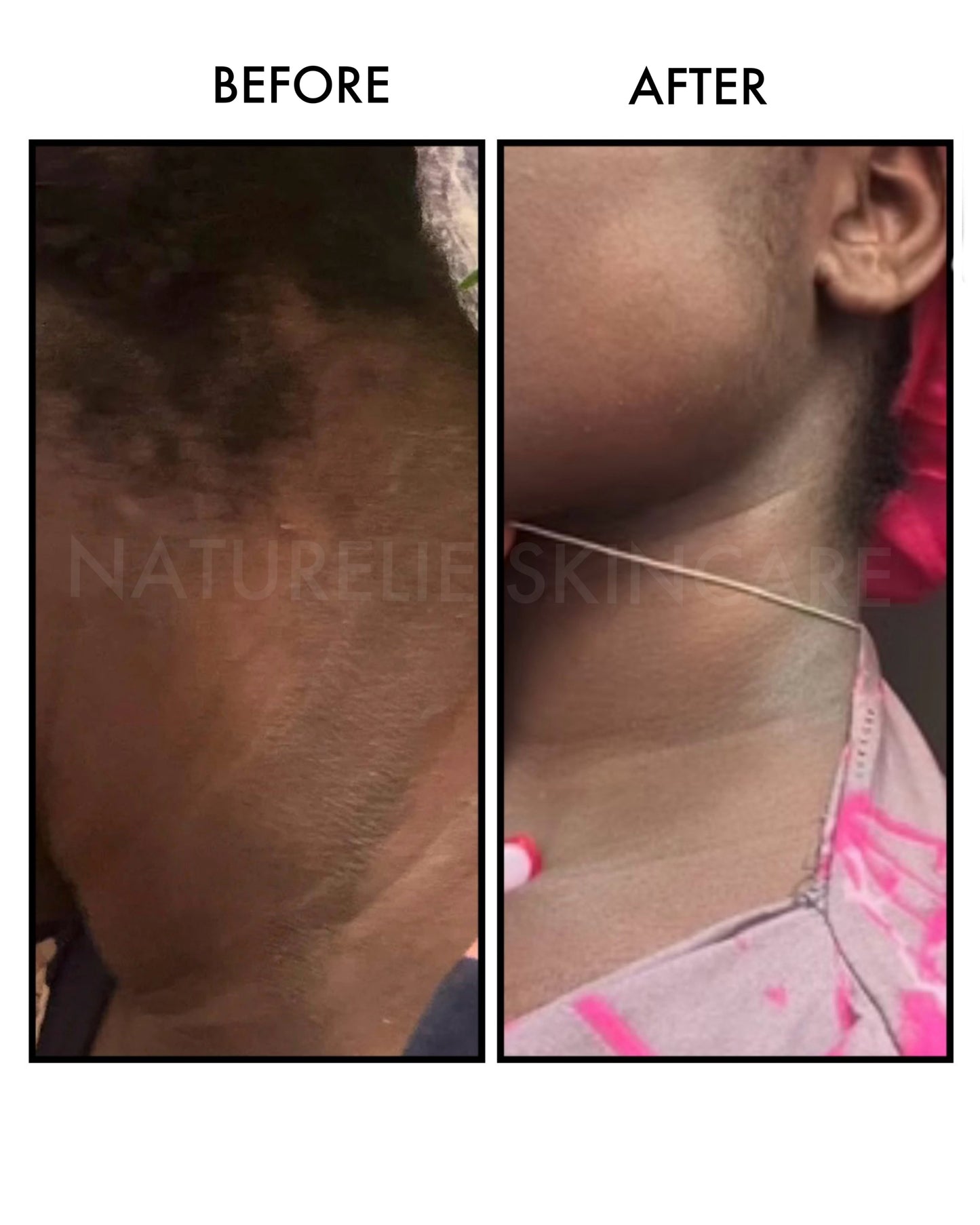 ECZEMA RELIEF BODY BUTTER