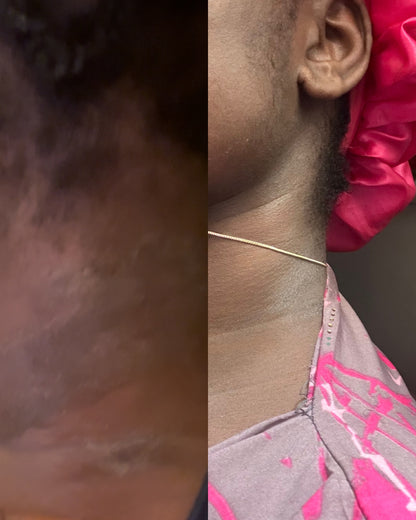 ECZEMA RELIEF BODY BUTTER